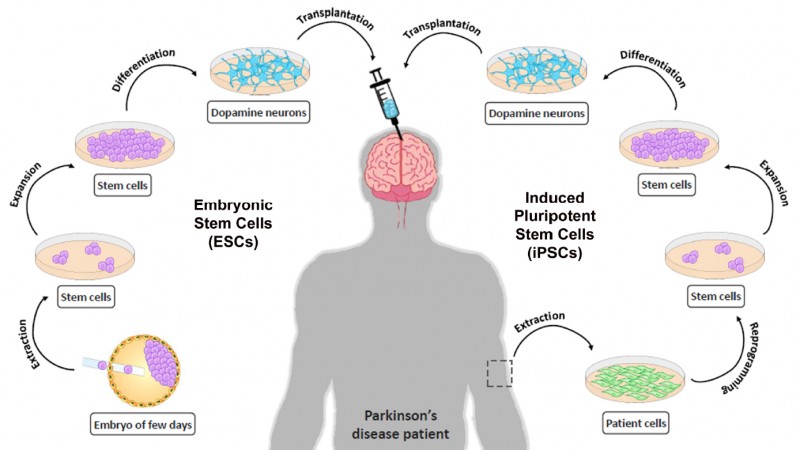 11 Complications Of Parkinson's Disease