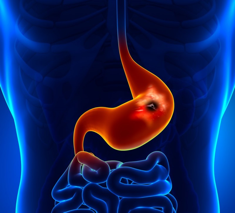 6 Warning Signs of Stomach Cancer