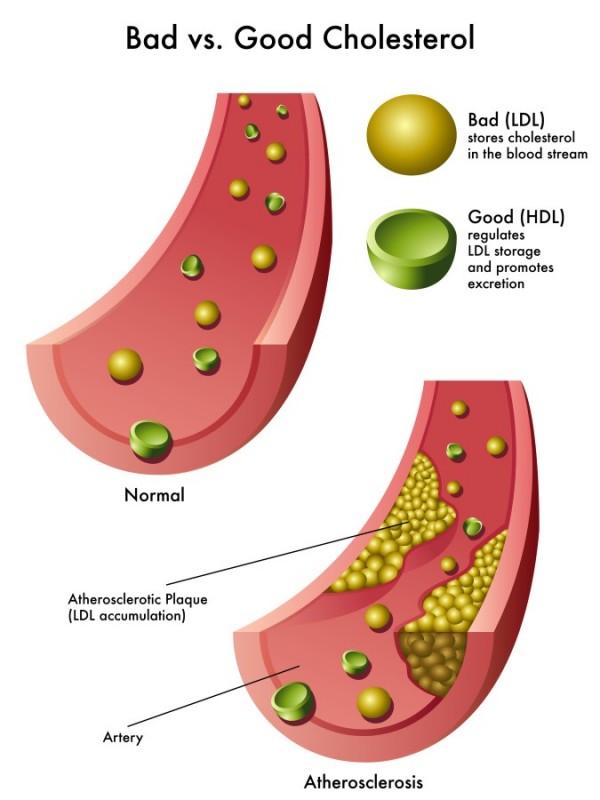 Can Cottonseed Oil Help Lower Your 'Bad' Cholesterol?