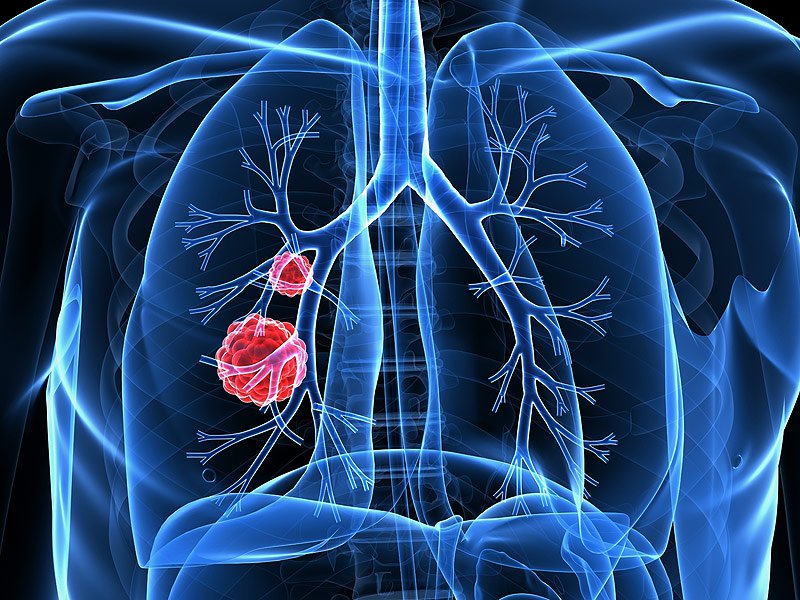 Common Drug May Increase Lung Cancer Risk