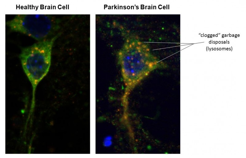 Could The Appendix Trigger Parkinson's?