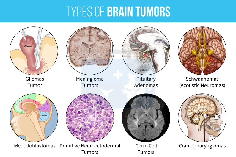 Does Brain Size Predict Brain Cancer Risk?