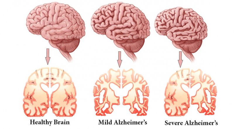 Eye Scan May Detect Early Alzheimer's Disease