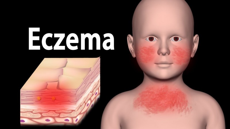 How To Treat Severe Eczema