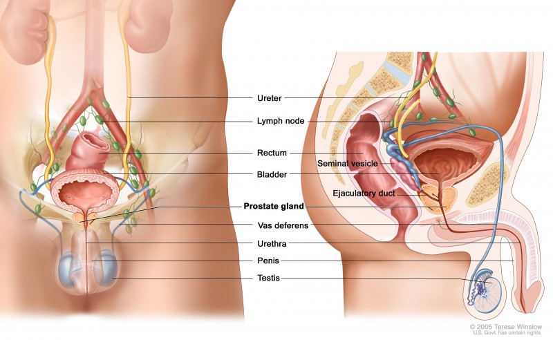 Metastatic Prostate Cancer: What You Need To Know