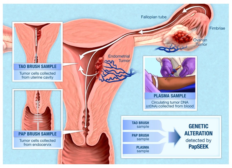 New Blood Test Can Detect Ovarian Cancer In Its Early Stages