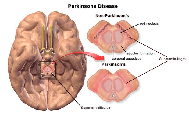 Parkinson's Disease: Scientists Find New Target to Destroy Protein Clumps