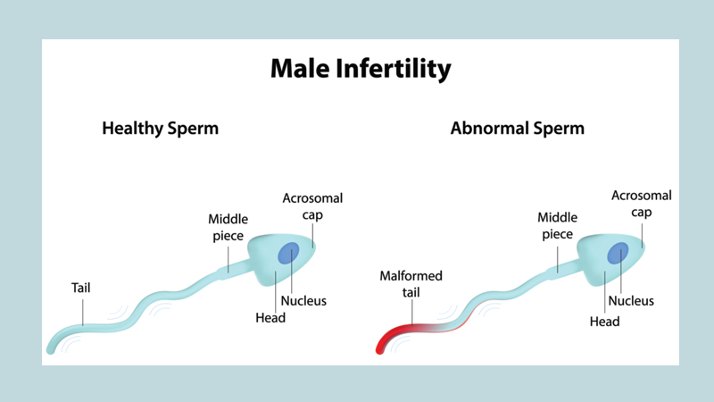 Signs and Symptoms of Infertility