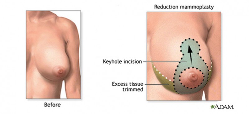 The Long-Term Outcomes Of Breast Implants Studied