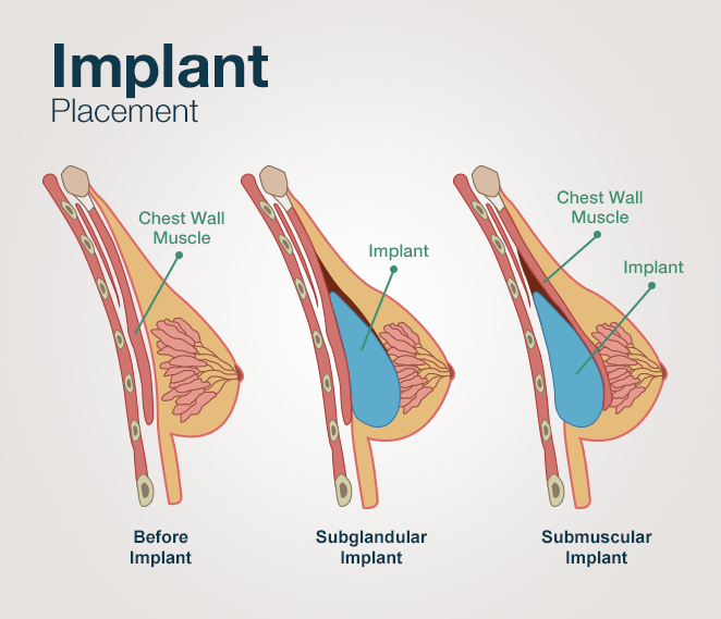 The Long-Term Outcomes Of Breast Implants Studied