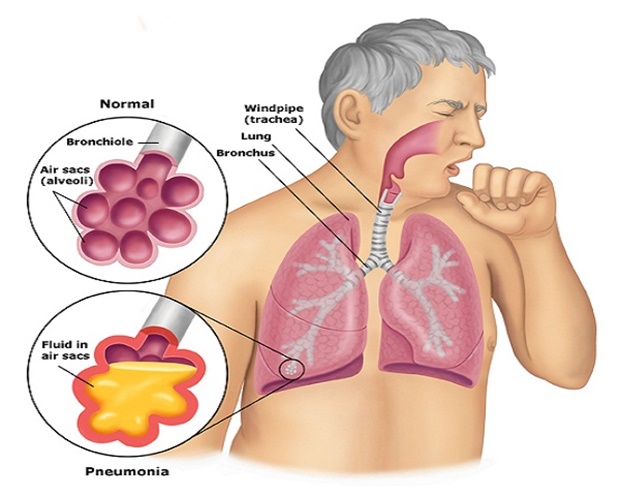 What Causes A Chronic Cough?