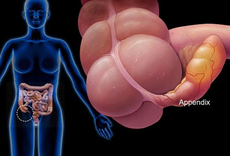 What Is Appendix Cancer?
