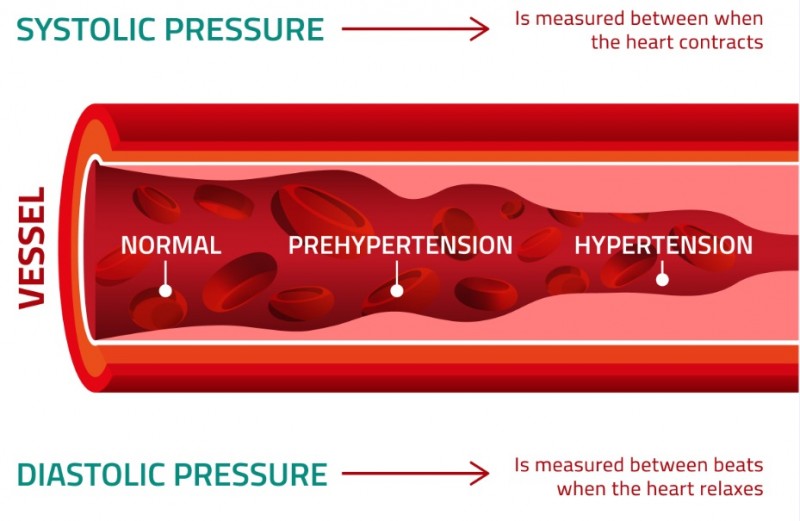 What Is Hypertension?