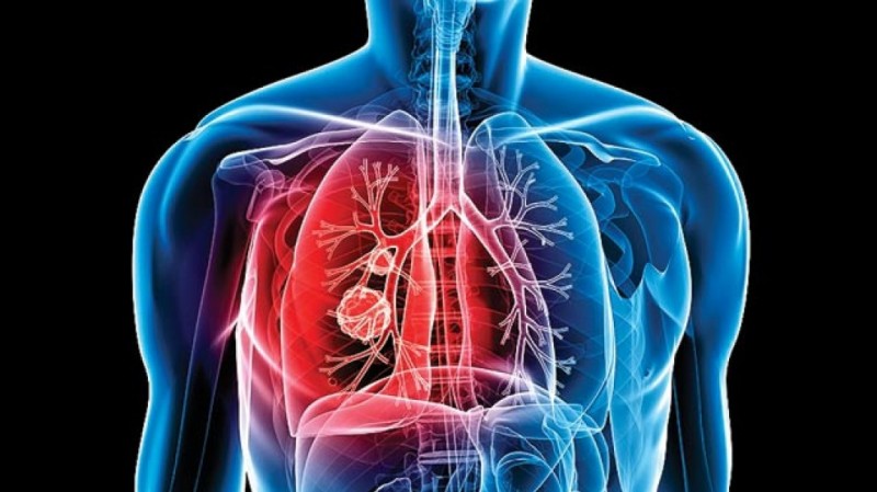 What Is Tuberculosis?