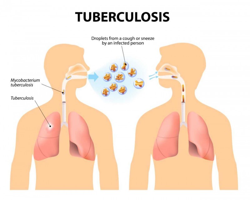 What Is Tuberculosis?