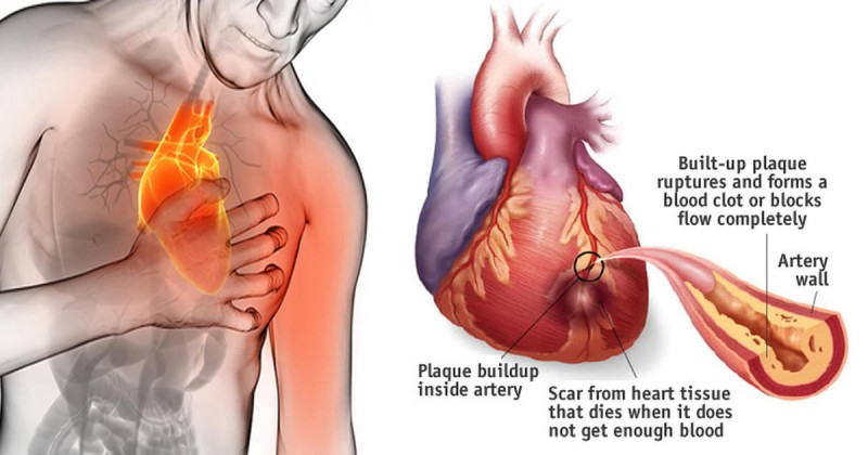 What You Can Do to Prevent a Heart Attack