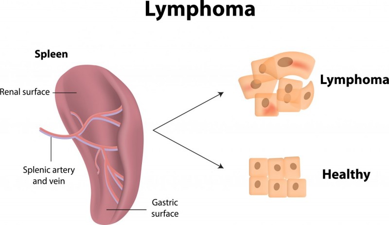 What You Need To Know About Lymphoma