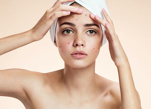 The Best Skin-Care Routine for Acne-Prone Skin