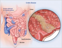 Are Probiotics Good or Bad for Crohn's Disease?