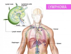 What You Need To Know About Lymphoma
