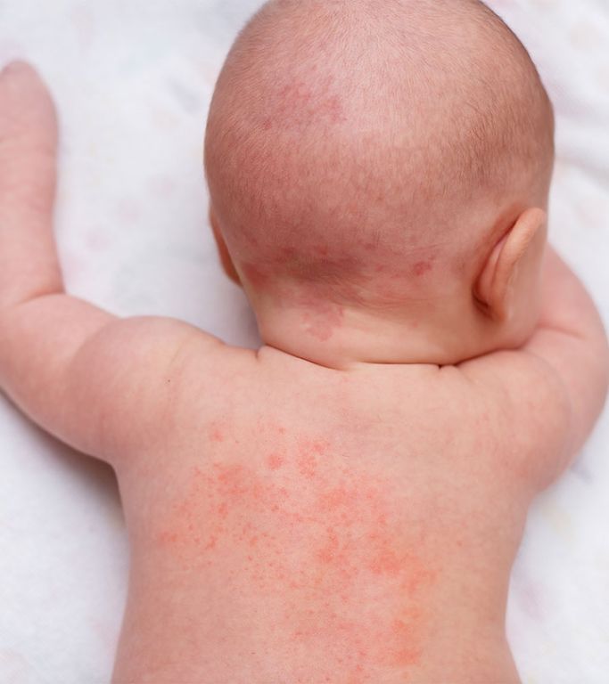 How To Get Rid Of Heat Rash On Babies