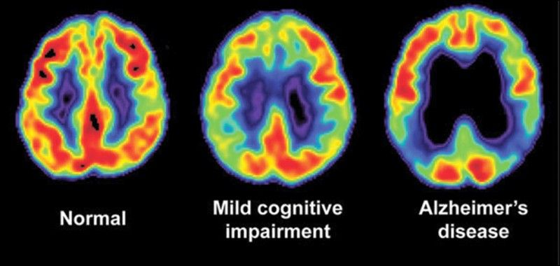 Eye Scan May Detect Early Alzheimer's Disease