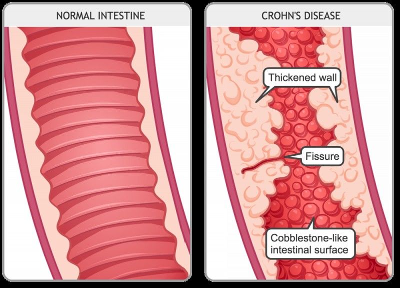 Are Probiotics Good or Bad for Crohn's Disease?