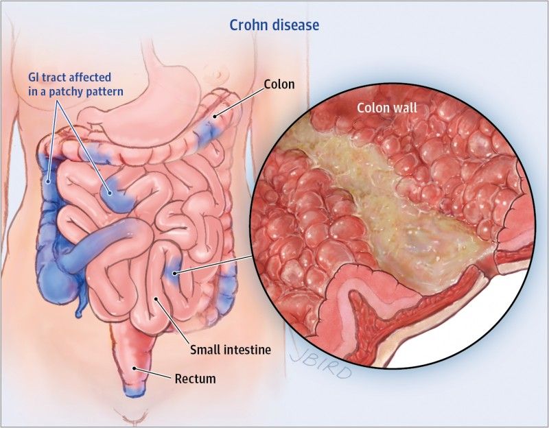 Crohn hastalığı