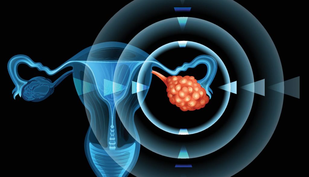5 Early Warning Signs Of Ovarian Cancer Women Should Never Ignore