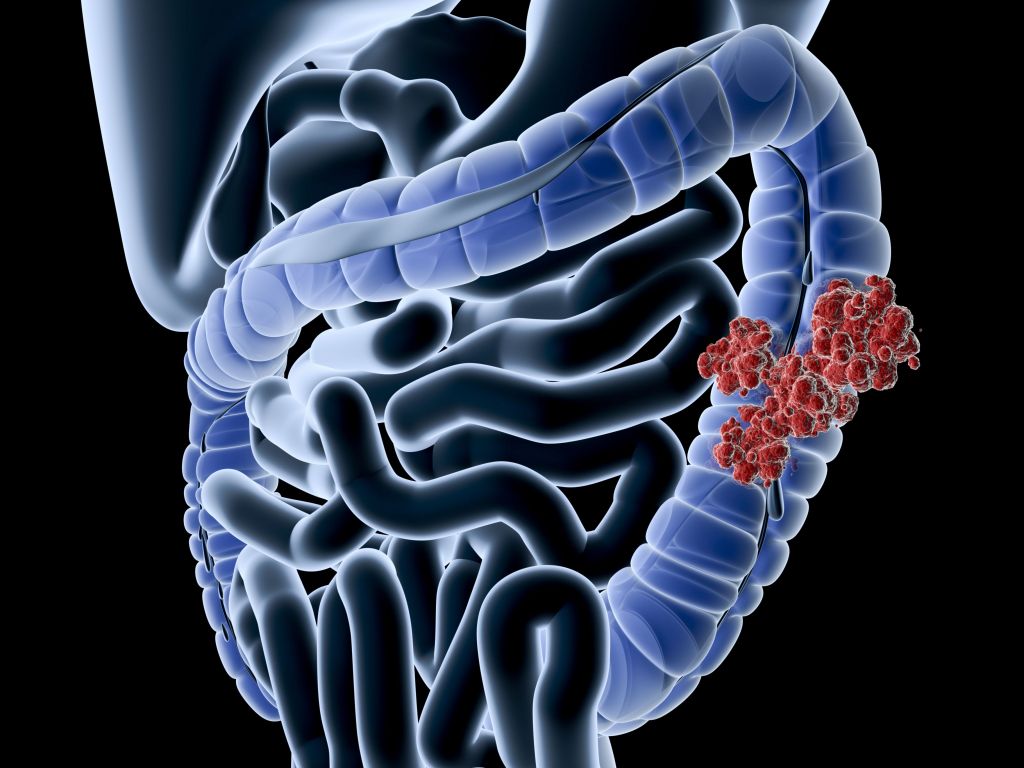 Colon Cancer: Could Exercise Halt Tumor Growth?